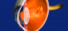 Retinopathy/ROP